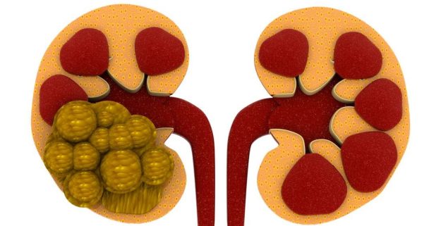 Πως δημιουργούνται οι πέτρες στα νεφρά;