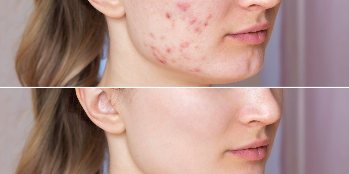 Πώς να Απαλλαγείτε από τις Ουλές και τα Σημάδια Ακμής