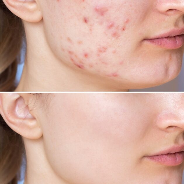 Πώς να Απαλλαγείτε από τις Ουλές και τα Σημάδια Ακμής