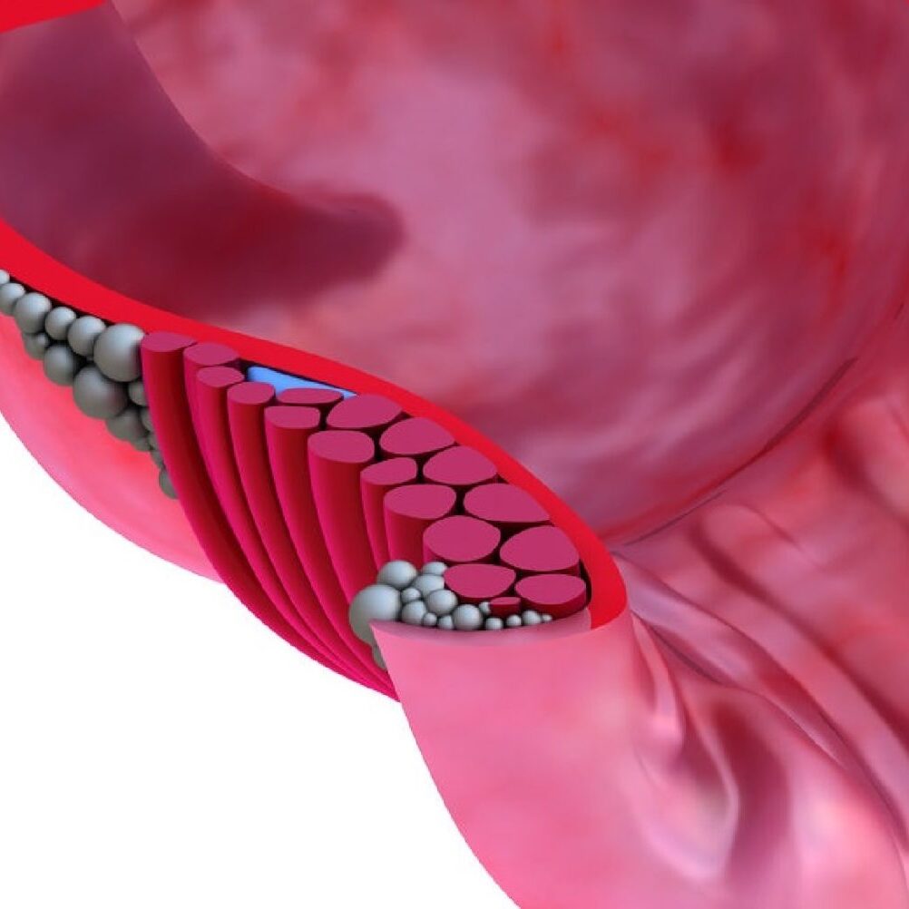 Ραγάδες πρωκτού, αίτια, συμπτώματα, αντιμετώπιση