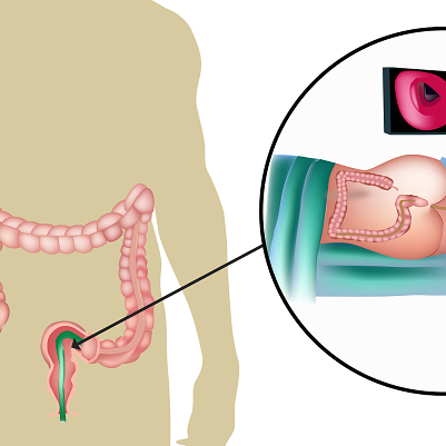 Σιγμοειδοσκόπηση, προετοιμασία, αποτελέσματα