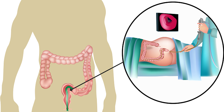 Σιγμοειδοσκόπηση, προετοιμασία, αποτελέσματα