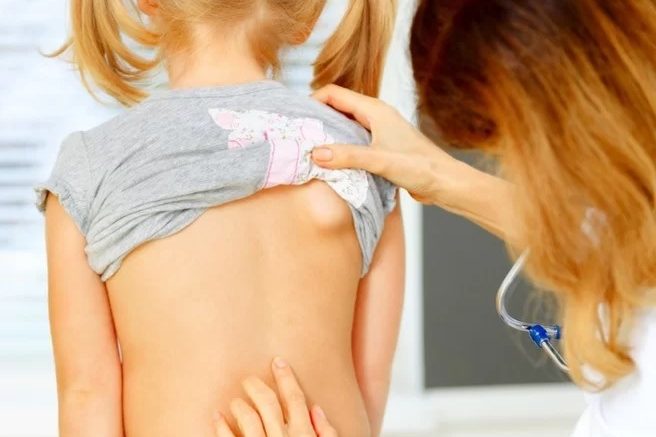 Σκολίωση & Παιδιά: Όλα όσα πρέπει να γνωρίζουν οι γονείς!