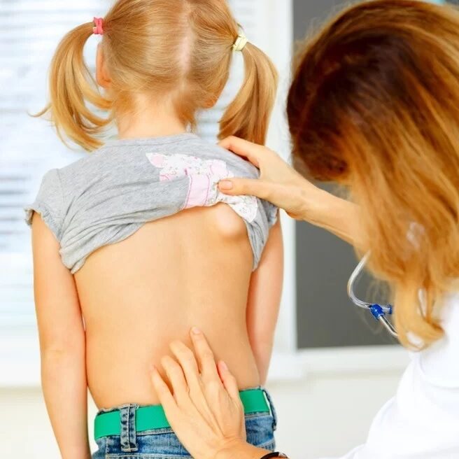 Σκολίωση & Παιδιά: Όλα όσα πρέπει να γνωρίζουν οι γονείς!