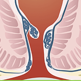 Συμπτώματα του καρκίνου του ορθού έναντι των αιμορροΐδων