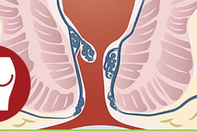 Συμπτώματα του καρκίνου του ορθού έναντι των αιμορροΐδων