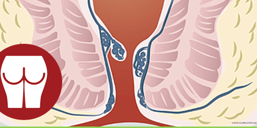 Συμπτώματα του καρκίνου του ορθού έναντι των αιμορροΐδων