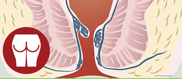 Συμπτώματα του καρκίνου του ορθού έναντι των αιμορροΐδων