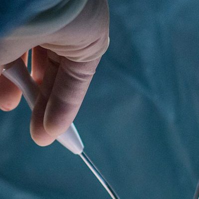 Συρραμμένη αιμορροϊδεκτομή