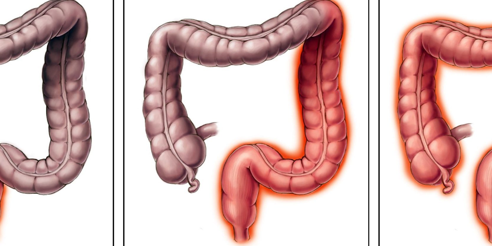 Συχνές ερωτήσεις για την πρωκτίτιδα