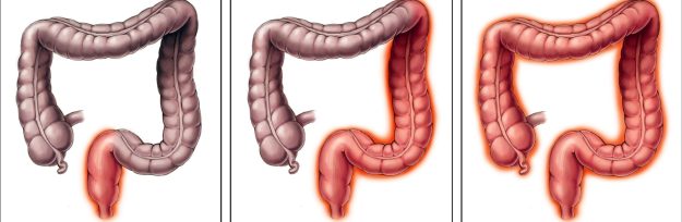 Συχνές ερωτήσεις για την πρωκτίτιδα