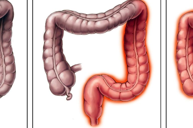 Συχνές ερωτήσεις για την πρωκτίτιδα