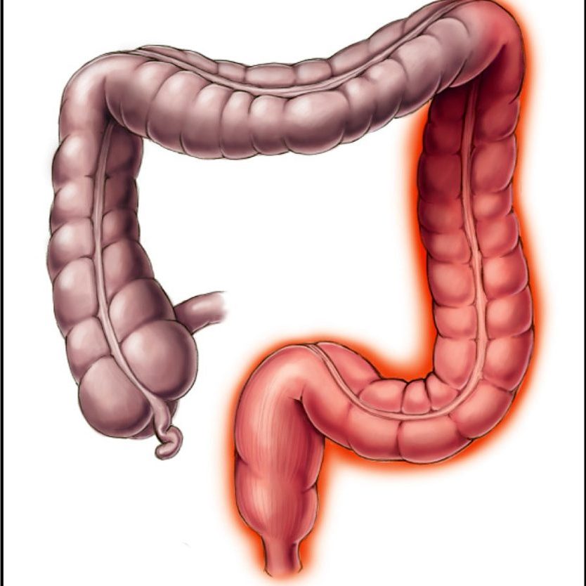Συχνές ερωτήσεις για την πρωκτίτιδα