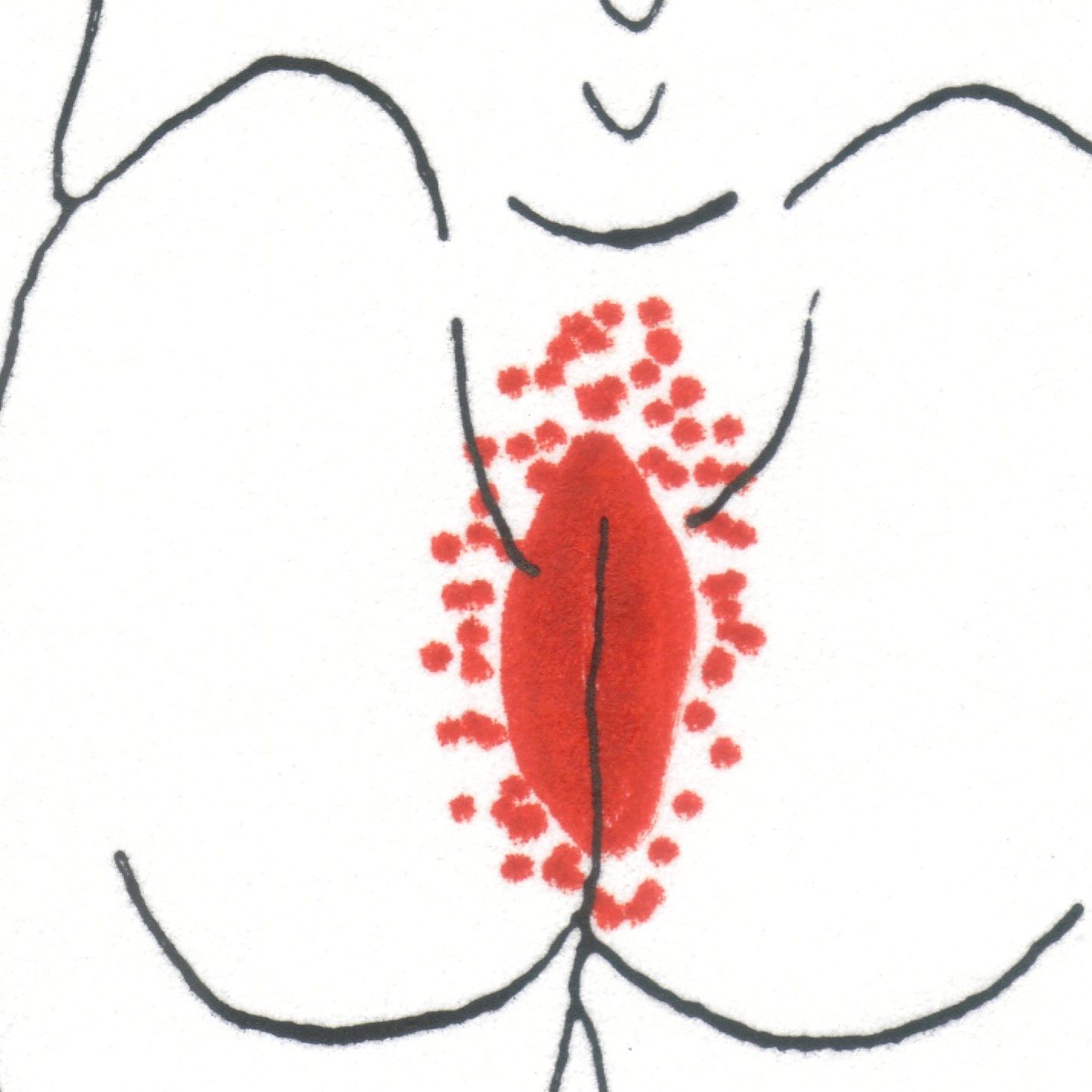 Σύνδρομο Levator