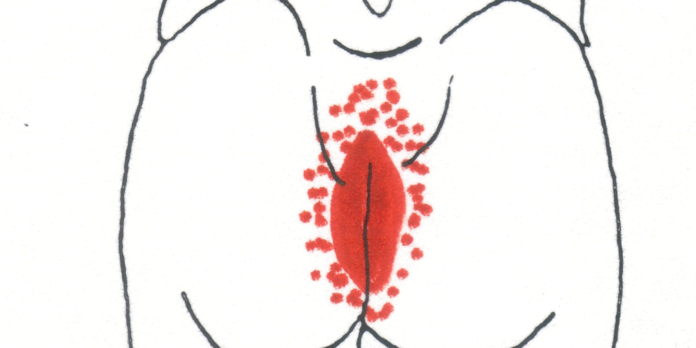 Σύνδρομο Levator Σύνδρομο Levator