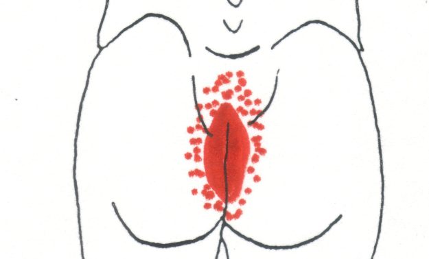 Σύνδρομο Levator