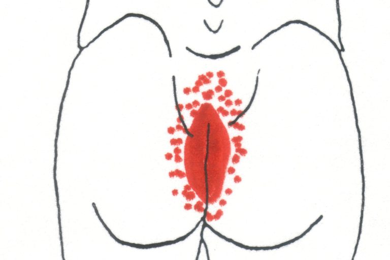 Σύνδρομο Levator Σύνδρομο Levator