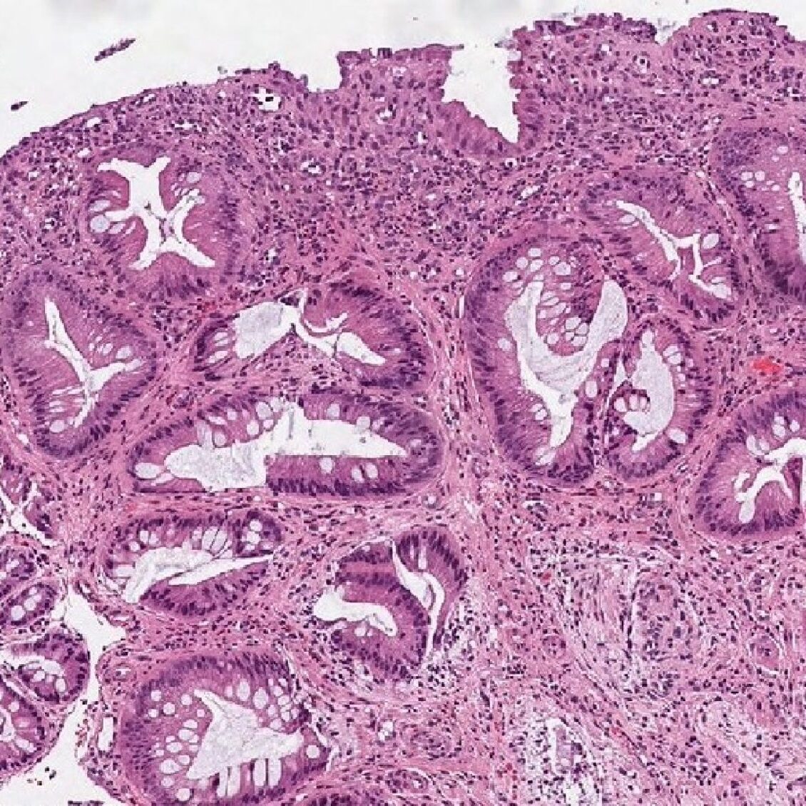 Σύνδρομο μονήρους έλκους του ορθού