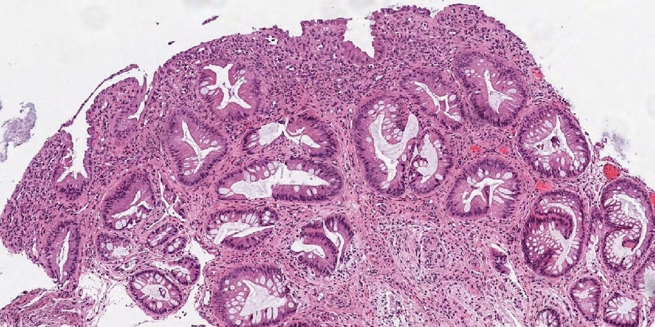 Σύνδρομο μονήρους έλκους του ορθού