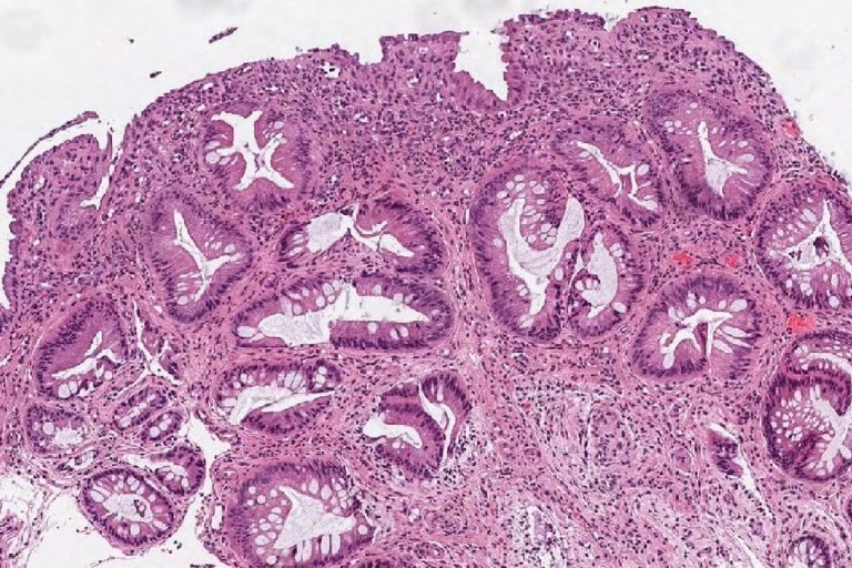 Σύνδρομο μονήρους έλκους του ορθού