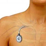 ΤΟΠΟΘΕΤΗΣΗ ΜΟΝΙΜΟΥ ΦΛΕΒΙΚΟΥ ΚΑΘΕΤΗΡΑ PORT-A-CATH