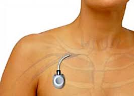 ΤΟΠΟΘΕΤΗΣΗ ΜΟΝΙΜΟΥ ΦΛΕΒΙΚΟΥ ΚΑΘΕΤΗΡΑ PORT-A-CATH