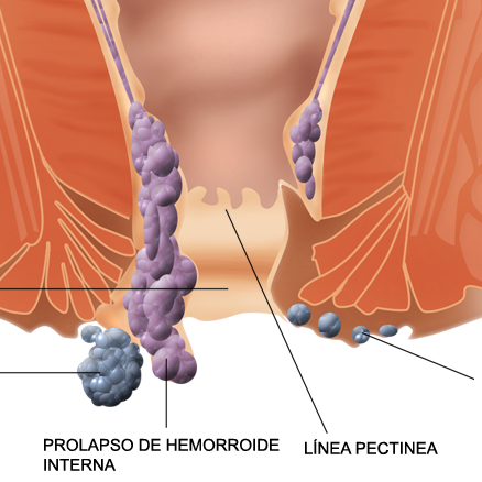 Ταξινόμηση των αιμορροΐδων