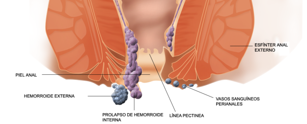 Ταξινόμηση των αιμορροΐδων