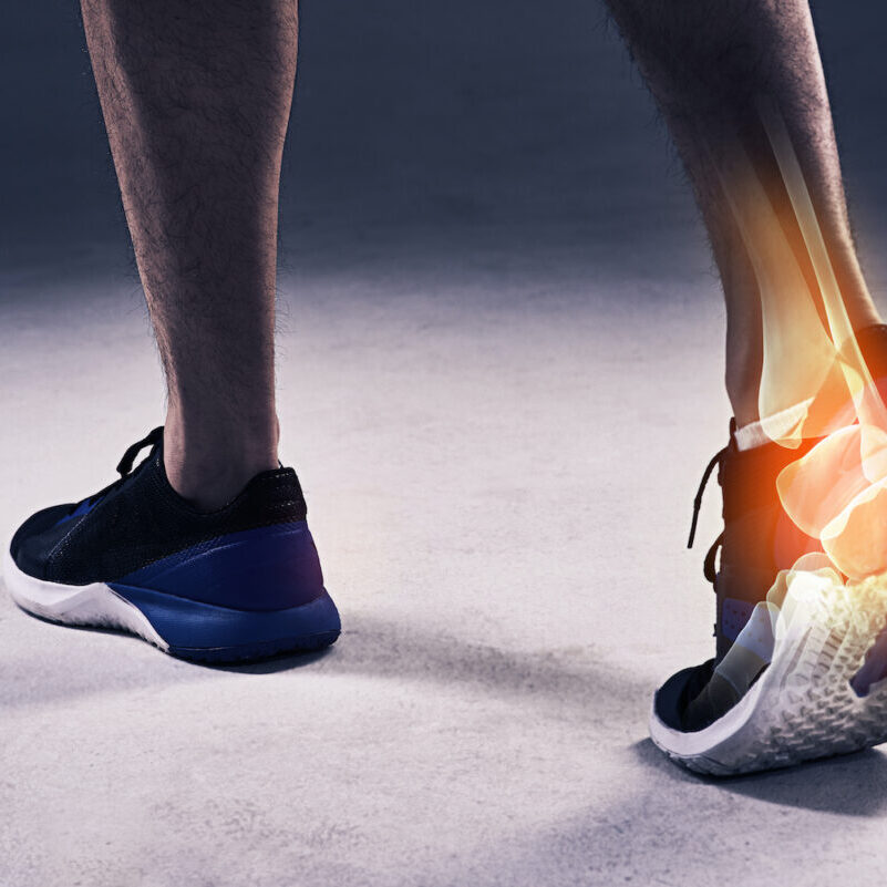 Τενοντίτιδα αχίλλειου τένοντα: Αίτια, συμπτώματα & θεραπεία