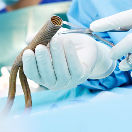 Τι Είναι Η Αγγειοχειρουργική;