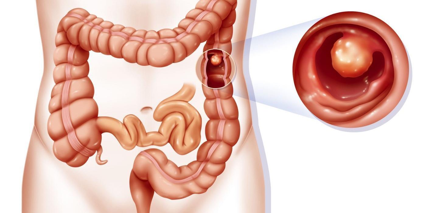 Τι είναι η ημικολεκτομή;