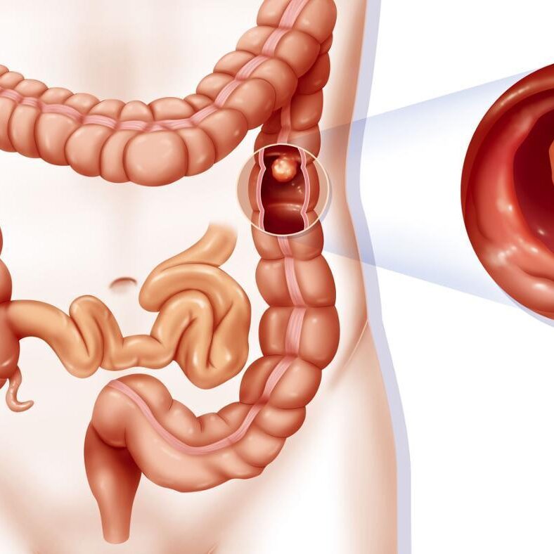Τι είναι η ημικολεκτομή;