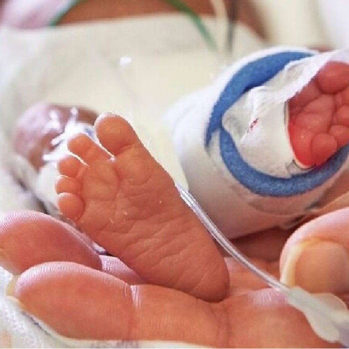 Τι είναι η νεκρωτική εντεροκολίτιδα