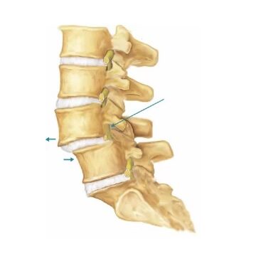 Τι είναι η σπονδυλολίσθηση;