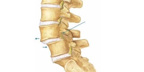 Τι είναι η σπονδυλολίσθηση;