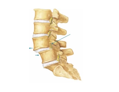 Τι είναι η σπονδυλολίσθηση;