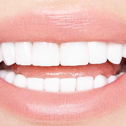 Τι είναι οι όψεις πορσελάνης;