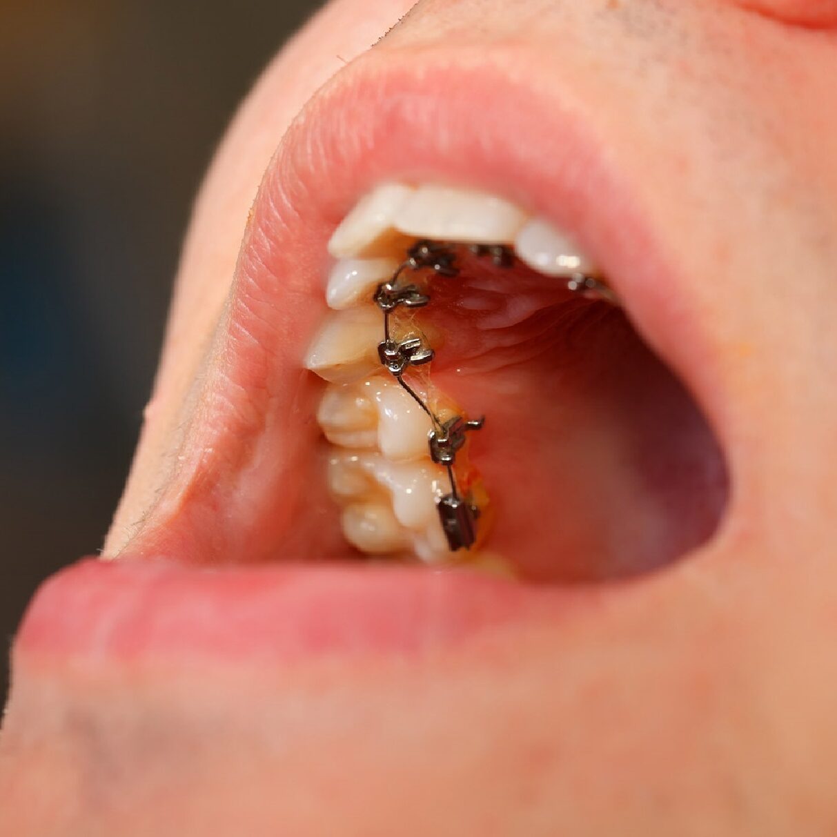 Τι είναι τα γλωσσικά εσωτερικά σιδεράκια;