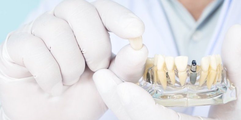 Τι είναι τα μικροεμφυτεύματα; Τι είναι τα μικροεμφυτεύματα;