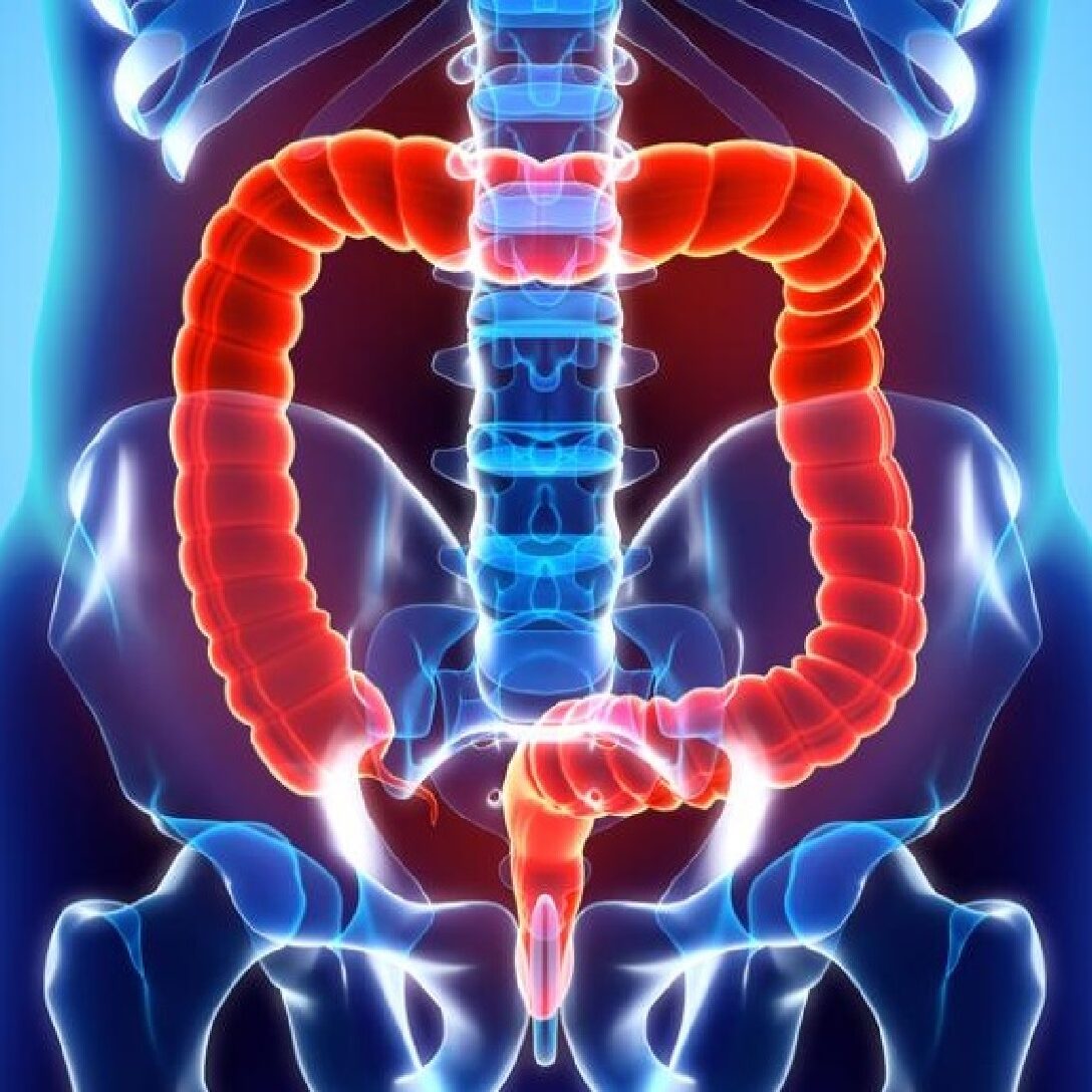 Τι πρέπει να γνωρίζετε για την ισχαιμική κολίτιδα