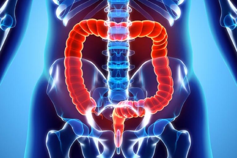 Τι πρέπει να γνωρίζετε για την ισχαιμική κολίτιδα