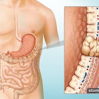 Τι πρέπει να γνωρίζετε για τους γαστρεντερικούς στρωματικούς όγκους