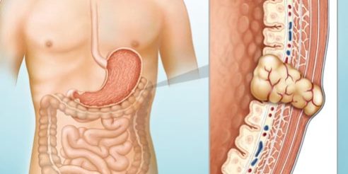 Τι πρέπει να γνωρίζετε για τους γαστρεντερικούς στρωματικούς όγκους Τι πρέπει να γνωρίζετε για τους γαστρεντερικούς στρωματικούς όγκους