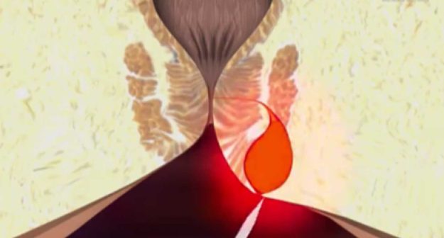 Τι προκαλεί πρωκτικό συρίγγιο;