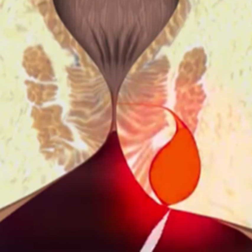 Τι προκαλεί πρωκτικό συρίγγιο;