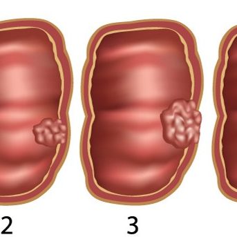 Τύποι πολύποδων του παχέος εντέρου