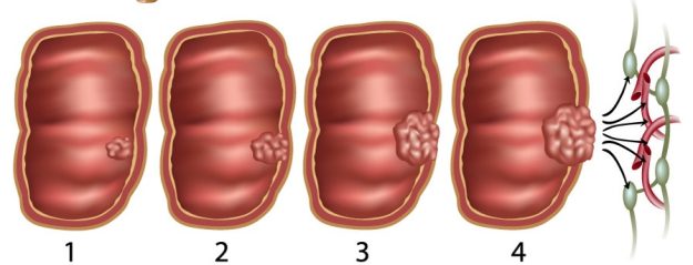 Τύποι πολύποδων του παχέος εντέρου