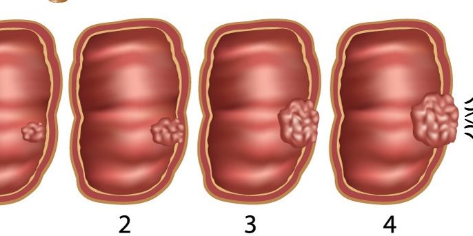 Τύποι πολύποδων του παχέος εντέρου