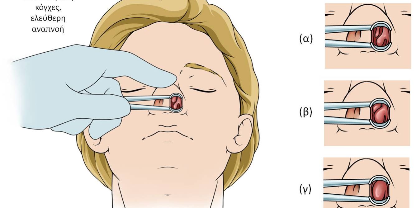 Υπερτροφία ρινικών κογχών: Μείωση για καλή αναπνοή