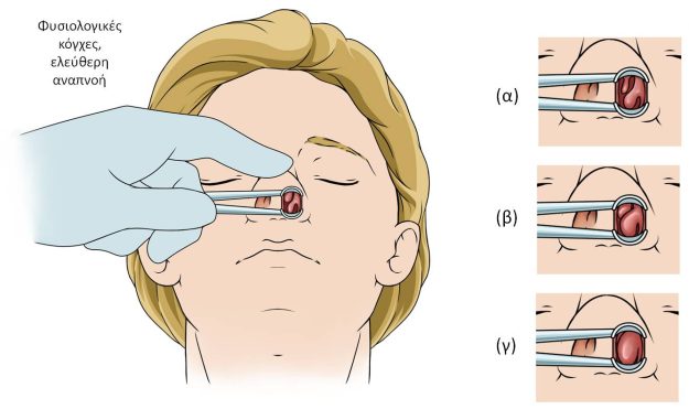 Υπερτροφία ρινικών κογχών: Μείωση για καλή αναπνοή